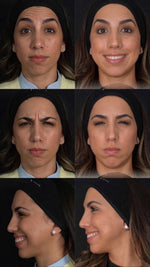 Botox™:Jeuveau™ in Miami: Natural-Looking Neuromodulator Injections