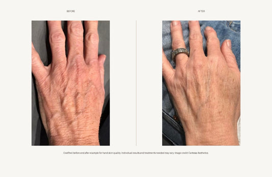 CO2 CoolPeel in Miami: Laser Skin Resurfacing for Texture, Pores, Fine Lines, and Sun Damage