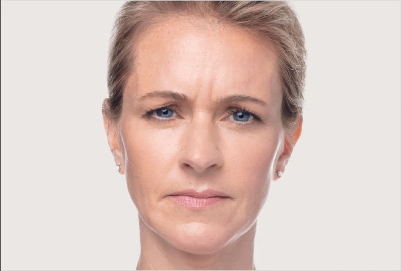 Dysport injection before patient result showing frown lines and wrinkles at Elda Silva Medspa Miami