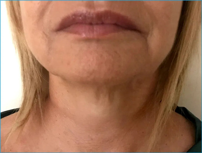 Endolift non-surgical facelift before and after results showing jawline contouring at Elda Silva Medspa Miami