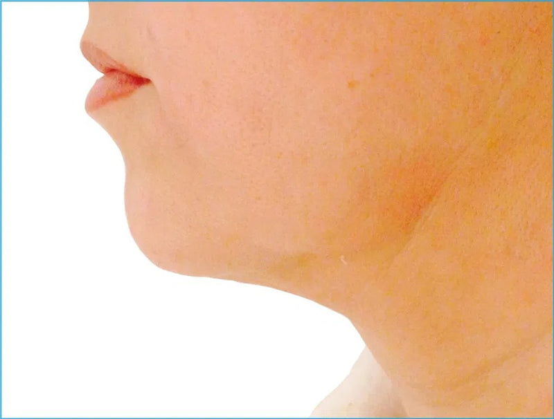 Endolift non-surgical facelift before and after results showing jawline contouring at Elda Silva Medspa Miami