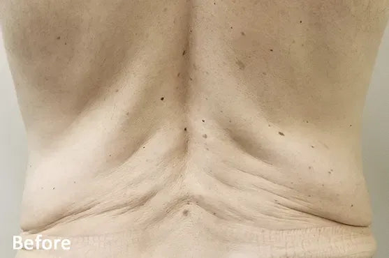 Morpheus8 body skin tightening before patient result showing back skin laxity at Elda Silva Medspa Miami